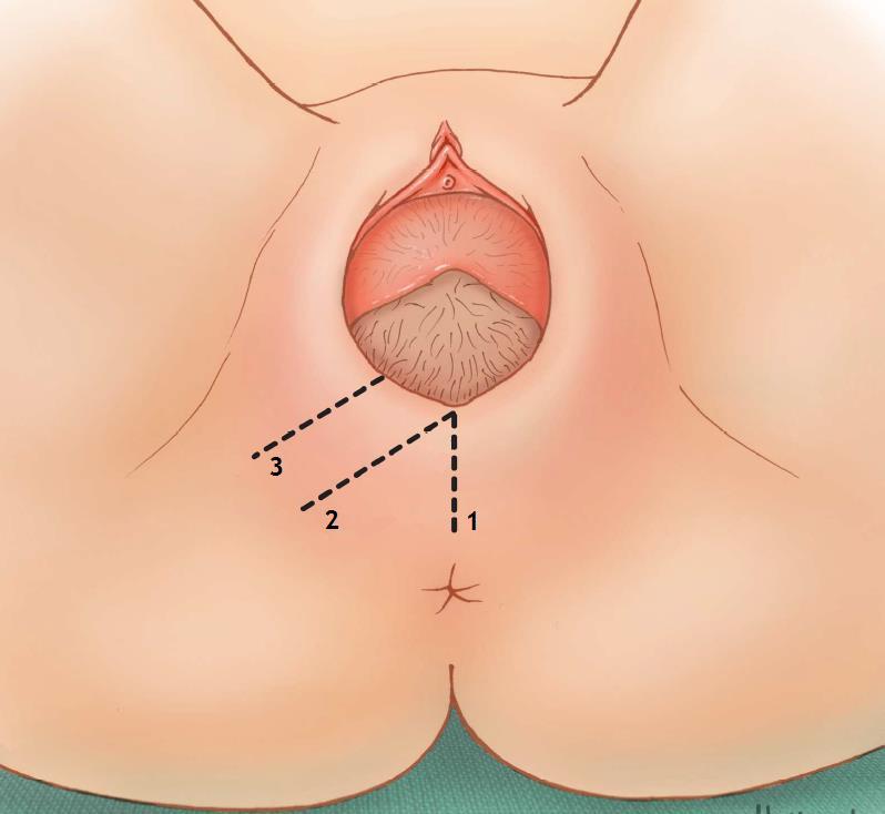 A.2 Ilustração das diferentes técnicas para realização da episiotomia Figura 2 - Diferentes técnicas