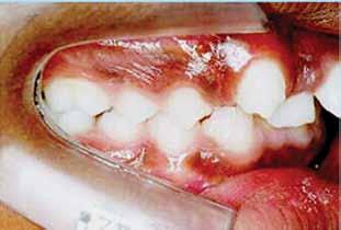 650 Carvalho, G.Y.; Ferrer, K.J.N; Ferrer, J.M.U; da sínfise mandibular).