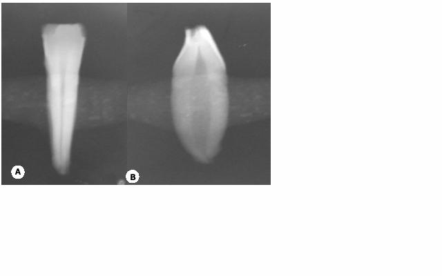 Material e Método 30 Figura 01. Radiografia de incisivos inferiores para seleção da amostra. A) vista de tomada vestíbulo-lingual. B) vista de tomada proximal.