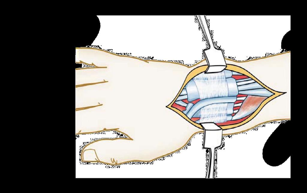 5. Complete a fixação Dois parafusos no fragmento distal e outros dois