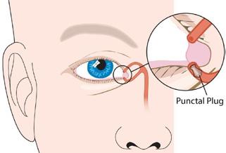 Um procedimento relativamente simples e indolor, estes dispositivos minúsculos e biocompatíveis são colocados na abertura dos dutos lacrimais para bloquear a drenagem da lágrima e manter os olhos