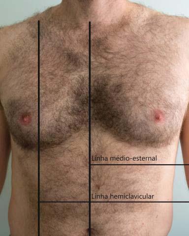 CAPÍTULO 9 Exame Físico do Sistema Respiratório 193 FIGURA 9-2 Linhas anteriores do tórax. Foto: arquivo dos autores. FIGURA 9-4 Linhas posteriores do tórax. Foto: arquivo dos autores. As linhas medioesternal e vertebral são precisas, e as demais, estimadas.
