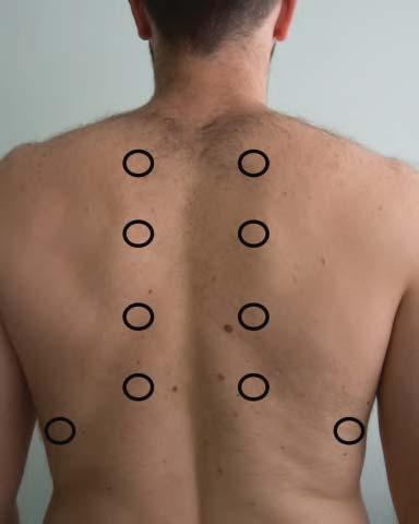 atelectasia por oclusão brônquica, no pneumotórax e no enfisema pulmonar. A seguir, a semiotécnica: Coloque o lado ulnar da mão direita, ou os dedos, sobre uma região superior do tórax anterior ( Fig.