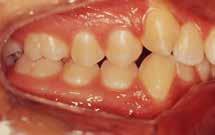 Pela análise de olton, havia discrepância dentária inferior, com excesso de 2,9mm no segmento anterior. radiografia panorâmica (Fig.