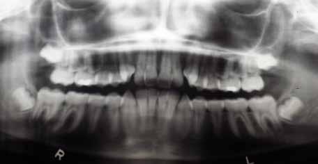 Para a correção do apinhamento superior, foi planejada a distalização e rotação dos molares, associadas à expansão da arcada dentária.