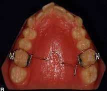 Depois de corrigido o giro dos molares, uma expansão de 1,5mm foi incorporada.