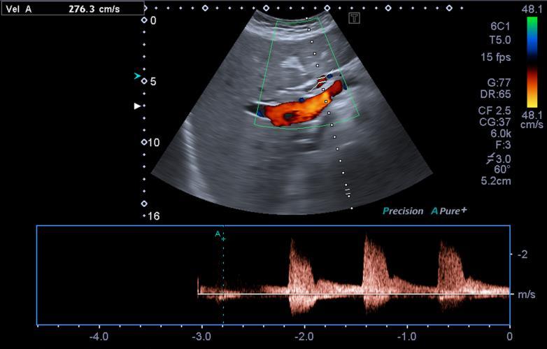 Aceleração (>0,08 segundos) Pico de velocidade sistólica (redondo) Onda do tipo Parvus Tardus Artéria hepática com