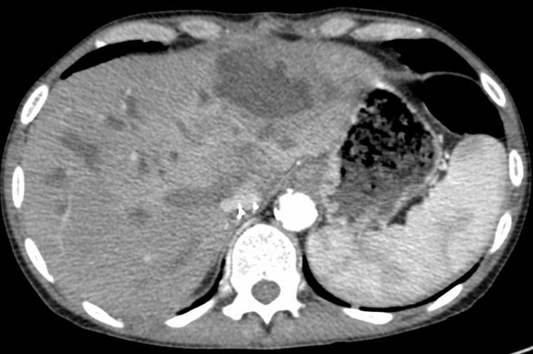 ARTÉRIA HEPÁTICA TROMBOSE Doppler Não