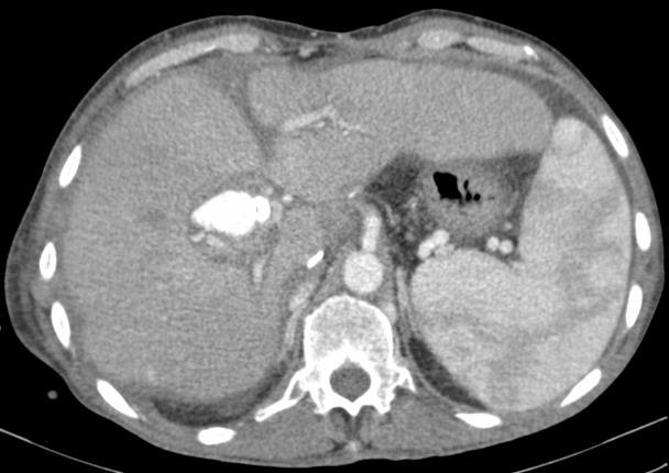 ARTÉRIA HEPÁTICA PSEUDO-ANEURISMA: Extra-hepático predileção pelo local da anastomose - complicação de angioplastia.