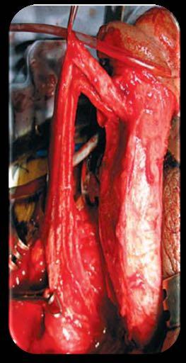 1. Degloving e exteriorização perineal 2. Separação do corpo esponjoso 3.