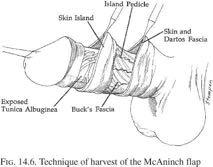 RETALHOS 1. McAninch and Morey flap (fasciocutâneo circular peniano) 12-15 cm 2.