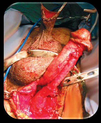 1. Degloving e exteriorização perineal 2. Separação do corpo esponjoso 3.