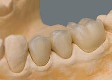 Técnica de sobre-injeção Individualização e aspectos clínicos Ponte de dente posterior finalizada no modelo de trabalho Aspectos clínicos Amostra Durante a prova, certifique-se de que as restaurações