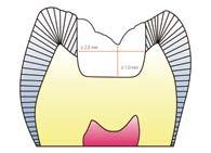 Técnica de injeção sem estrutura Espessuras de camada Inlays 1,5 mm 1,5 mm Espessuras