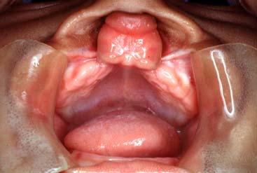 palato direita, LAPB: lábio, rebordo alveolar e palato bilateral)