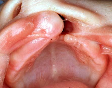 1 Fissura de lábio e rebordo alveolar esquerda (LAE) Fig.