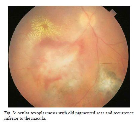 Complicações oculares mais frequência em crianças = neovascularização da coroide, catarata, glaucoma, atrofia do nervo óptico,