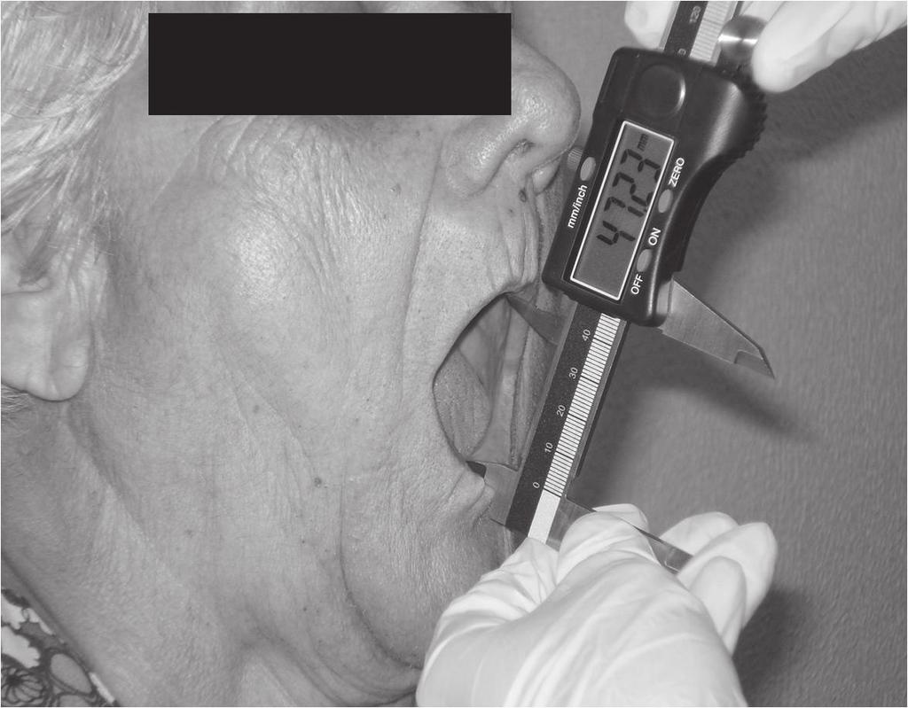 Para mensurar ao grau de abertura oral máximo (Figura 3), a voluntária foi mantida na mesma postura, e foi solicitado que a partir de uma posição confortável da mandíbula, abrisse a boca o máximo