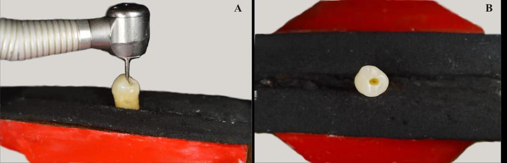 21 Figura 2. A-preparo para cavidade de acesso. B-vista oclusal da cavidade de acesso endodôntico realizada. Fonte: Autor.