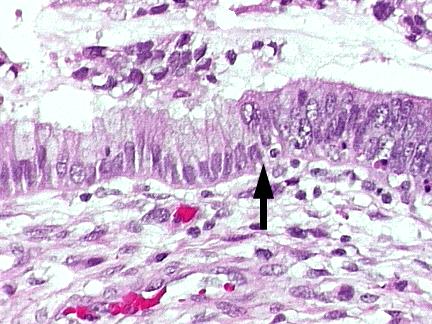 situ Adenocarcinoma invasor: