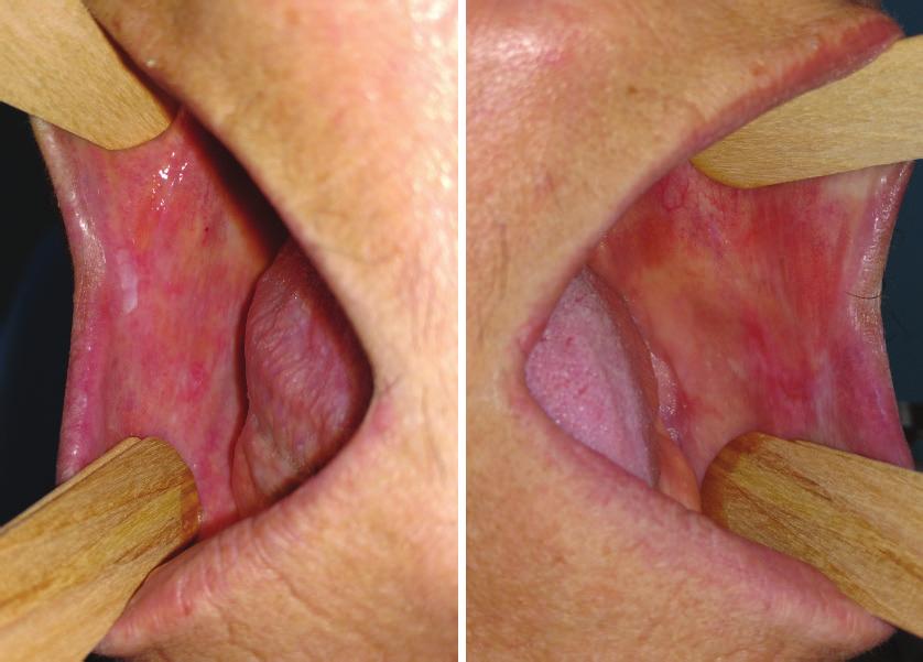 DINIZ JA, ET AL. Figura 2 - Aspecto da mucosa jugal antes bilateral após tratamento com propionato de clobetasol 0,5mg/g por 4 semanas.
