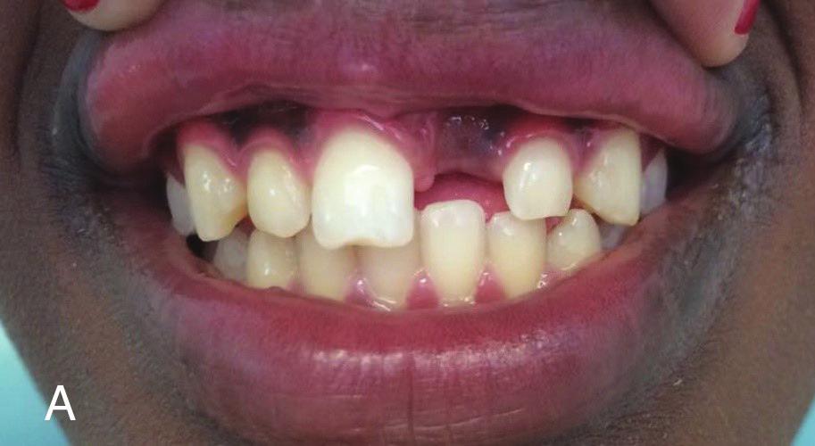 NASCIMENTO LJ, ET AL. INTRODUÇÃO O traumatismo buco-dentário pode acontecer em qualquer fase da vida, sendo muito comum em crianças na idade pré-escolar e escolar 1.