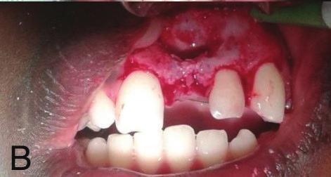 luxação e exérese da raiz dilacerada (Fig. 2, A, B, C). Figura 2 - A, Visualização do elemento dentário. B, Visualização de loja óssea.