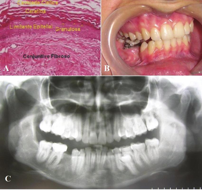FERREIRA LM, ET AL. As hipóteses diagnósticas foi para Cisto Dentígero, CO e Ameloblastoma. Durante biópsia incisional, notou-se presença de cápsula fina e material caseoso no interior da lesão.