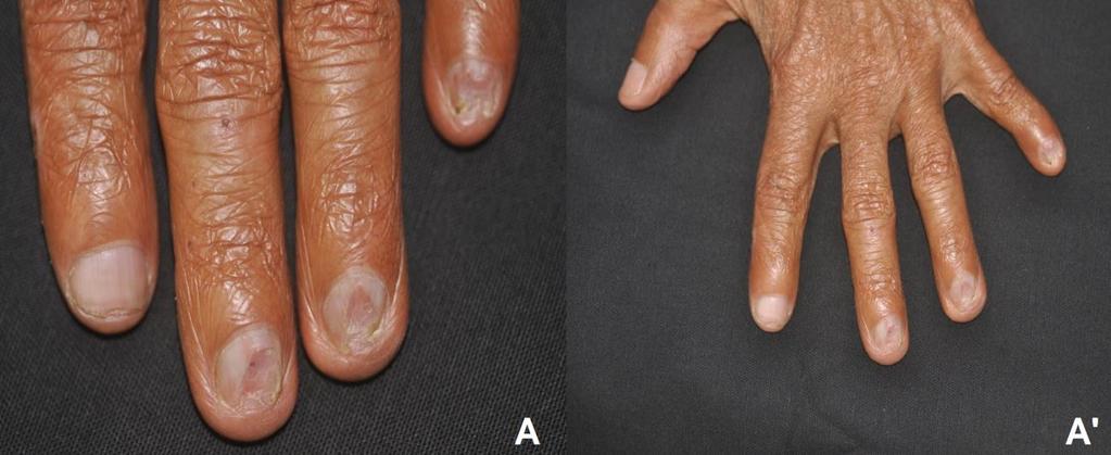 3 DISCUSSÃO Alterações ungueais são comuns na hanseníase e atribuídas a uma combinação de fatores como neuropatia, trauma, desordens vasculares e infecções.