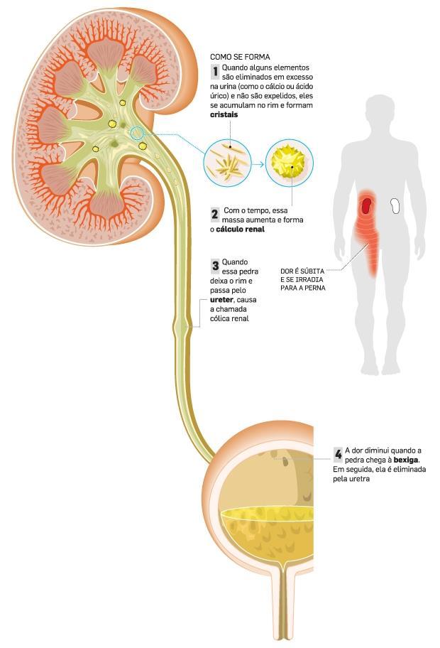 genital; Distúrbios Cálculo Renal Pesquise sobre as causas e sintomas dos seguintes Distúrbios do Sistema Urinário: