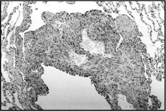 NA. Radiology 2000 Patologia Proliferação céls LAM