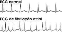 sequência de batimentos cardíacos irregulares e com frequência variada.
