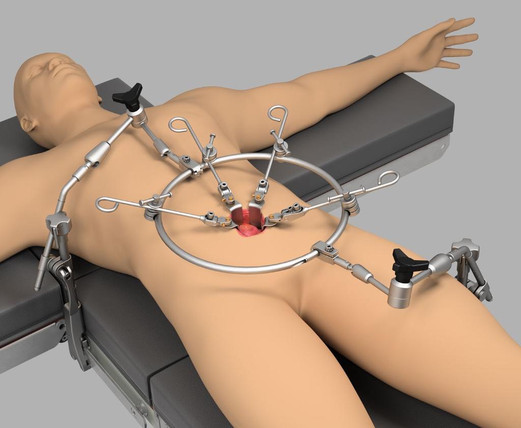 Uncompromised Exposure Thompson Anterior Lumbar Ring System User