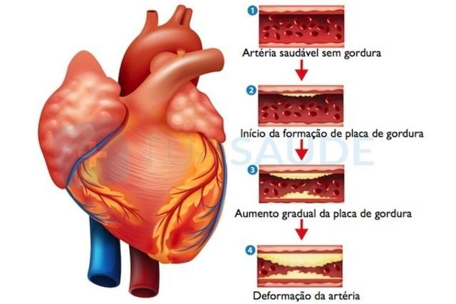 AngioTC Coronariana na Emergência No cenário da dor torácica aguda O Brasil apresenta