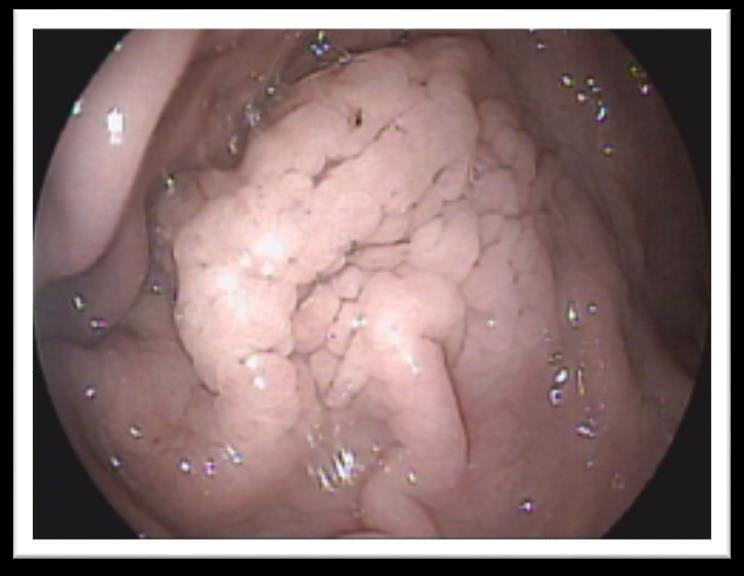 34 Figura 14: Terço distal de corpo gástrico apresentando hiperplasia da mucosa, com proliferação tecidual e presença de pequena lesão (seta preta). FONTE: BENVENHO, A. C. 2016.