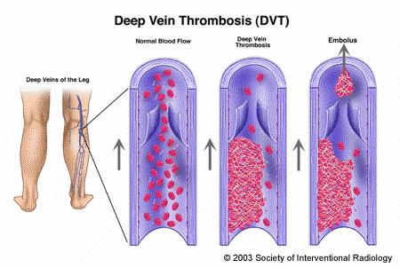 TVP Alterações Vasculares Trombose