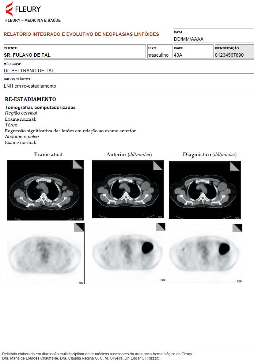 Integrated report: Hematology (Lymphoma) Lymphoma cell B with immunohistochemistry profile of activated cell B.