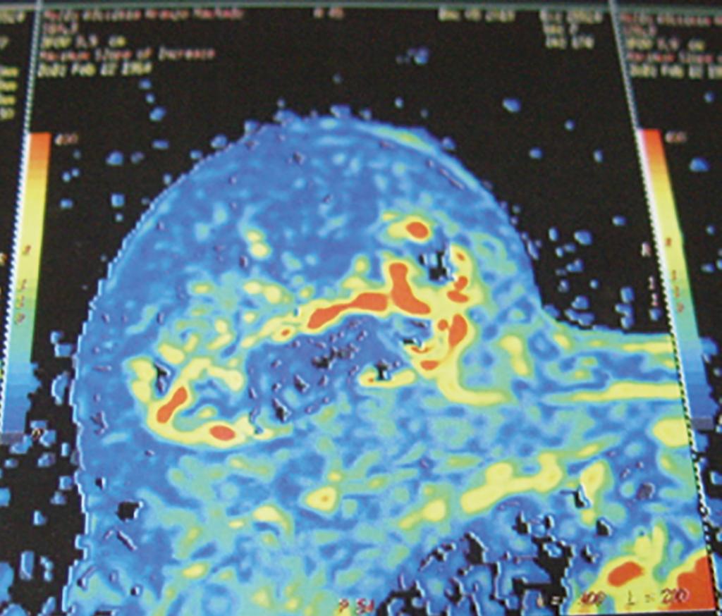 Barcelos LDP et al. www.rbcp.org.br Figura 3. Imagem de ressonância magnética da mama direita com área de esteatonecrose, presença de cisto oleoso. Figura 1.