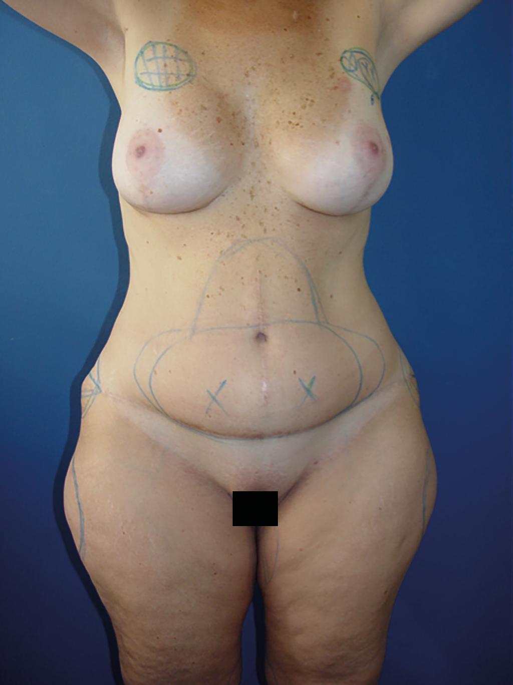 Alternativa técnica para tratamento de esteatonecrose em mama Delimitamos a área de necrose (Figura 4), e após infiltração rotineira da região, introduzimos a cânula no interior do nódulo necrosado e