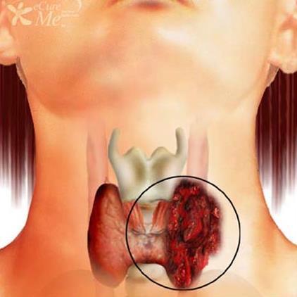 16 Figura 1: Ilustração do aspecto macroscópico do câncer da tireóide (fonte: www.ecureme.com).