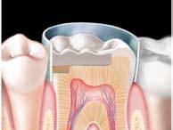 Defina a anatomia final da restauração com uma broca multilaminada ou ponta diamantada para acabamento. B.