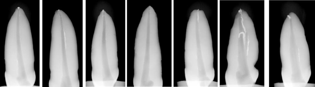 Variáveis analisadas Probabilidades Apical x Médio 0,107 Apical x Cervical 0,000* Médio x Cervical 0,001* (*) p < 0,05 De acordo com os resultados demonstrados na tabela 2, foram encontradas