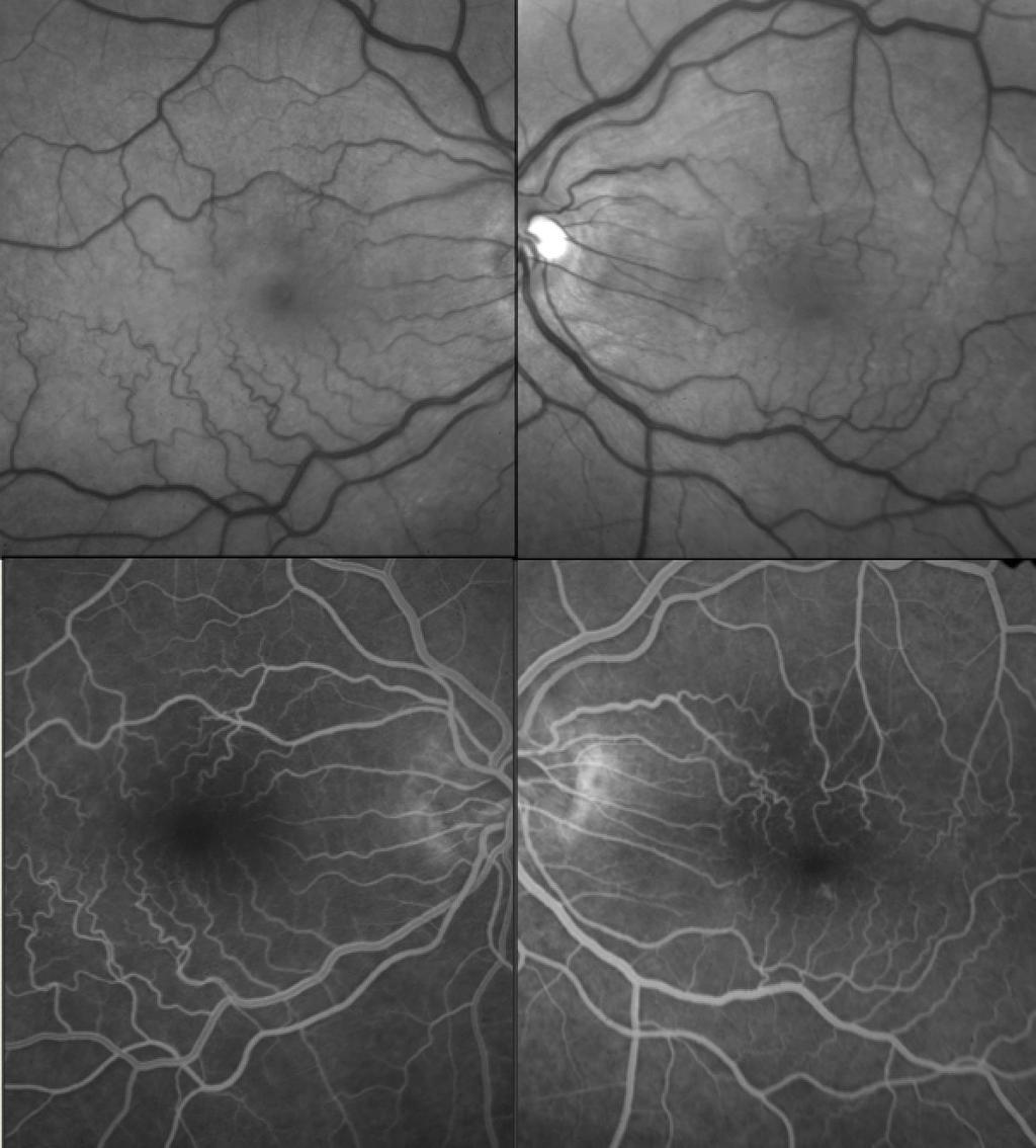 Introdução 6 Figura 1 - Imagem do estágio inicial da membrana epirretiniana.