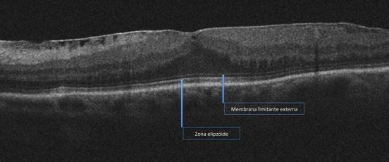 Materiais e Métodos 31 Com relação à espessura e volume macular, foi utilizado o valor calculado pelo aparelho no mapa do programa macular cube.