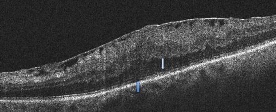 Materiais e Métodos 32 Figura 11 - Imagem da Tomografia de Coerência Óptica (OCT) em paciente portador de membrana epirretiniana com alteração moderada da retina externa.