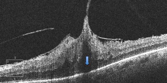Figura 12 - Imagem da Tomografia de Coerência Óptica (OCT) em paciente portador de membrana epirretiniana com significativa alteração da retina externa.