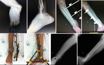 44 Resultados Fonte: Arquivo pessoal da pesquisadora Figura 2 - Paciente sexo masculino, 30 anos, vítima de acidente motociclístico com fratura exposta do terço distal da perna.