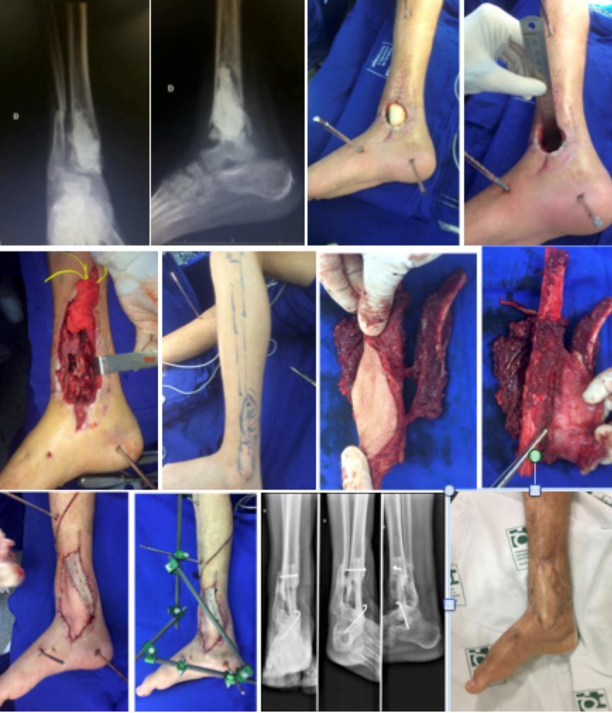 63 Resultados Figura 9 - Paciente sexo masculino, 38 anos, após fratura de tornozelo direito evoluiu com infecção pós-operatória e encaminhado ao IOT- HCFMUSP para tratamento de lesão.