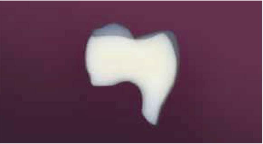 Orthognath / Orthocal Dentes posteriores Classic Orthognath Dentes posteriores com conceito anatômico de oclusão Os dentes posteriores Orthognath possuem duas camadas, são confeccionados com