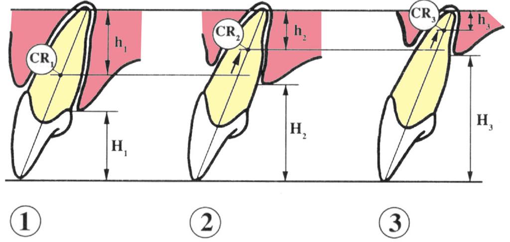25 Figura 3 - Variação do centro de resistência de um dente em função da altura da crista óssea alveolar Fonte: Valet e Pagin (1987).